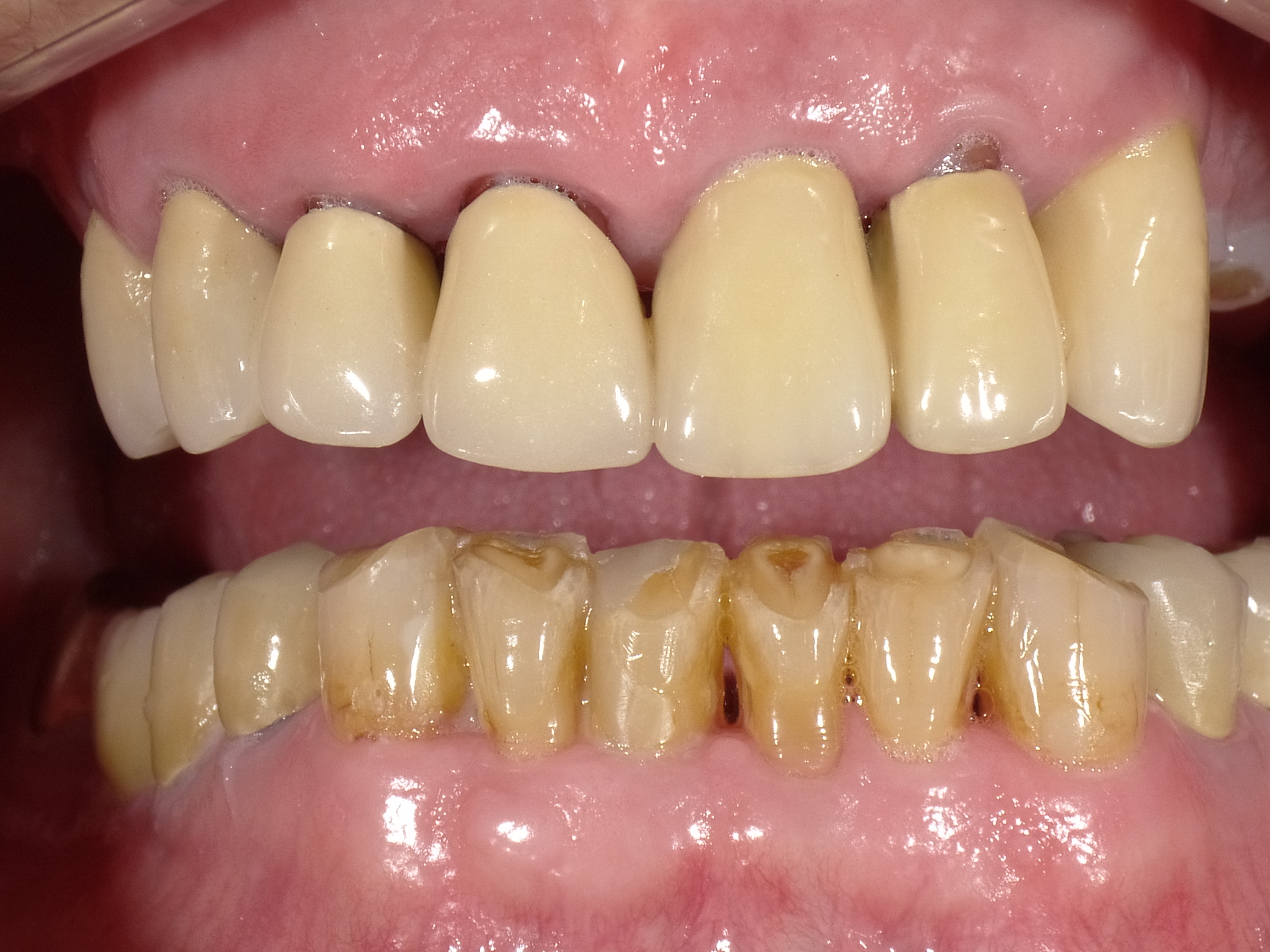 Unzufriedener Patient nach langjähriger Betreuung durch seinen "Hauszahnarzt" bei ihm im Dorf